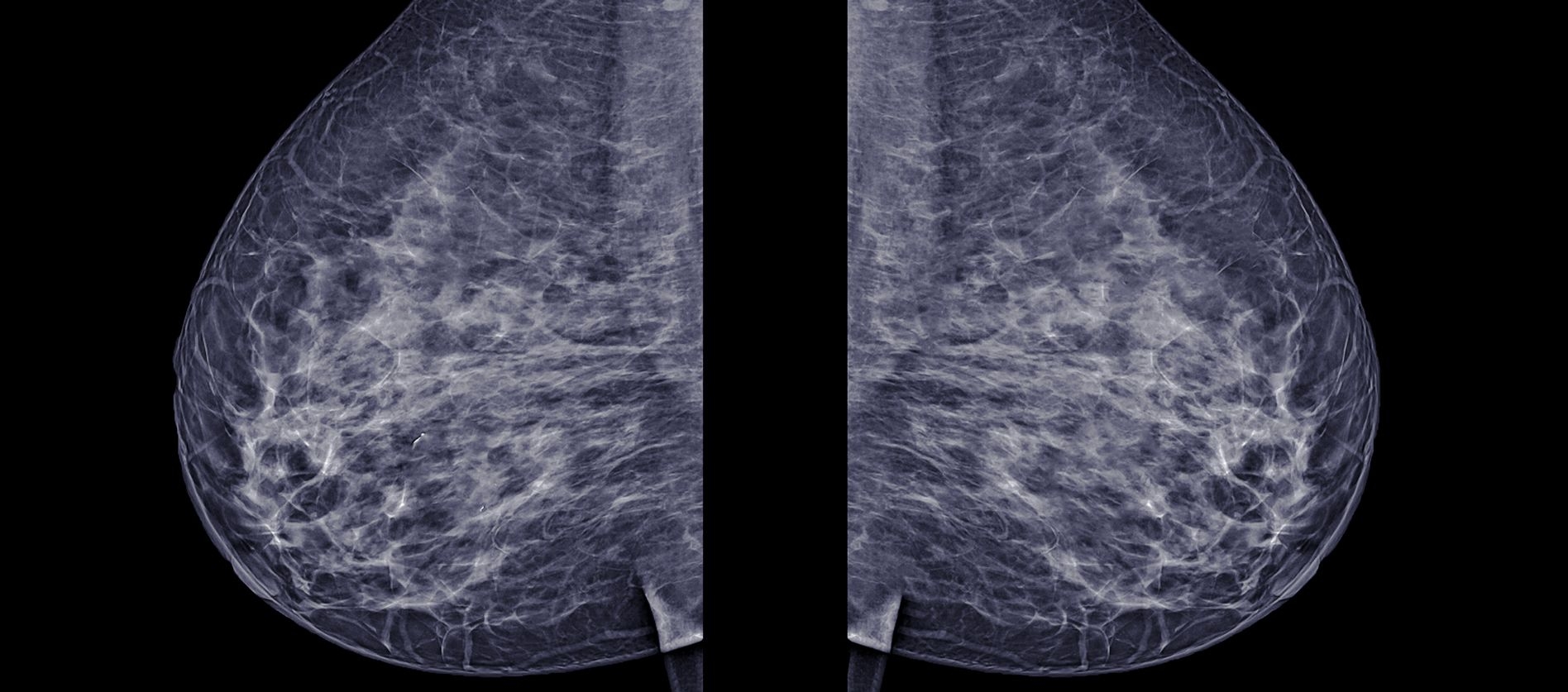 Mamma Carcinom - Brust Krebs image