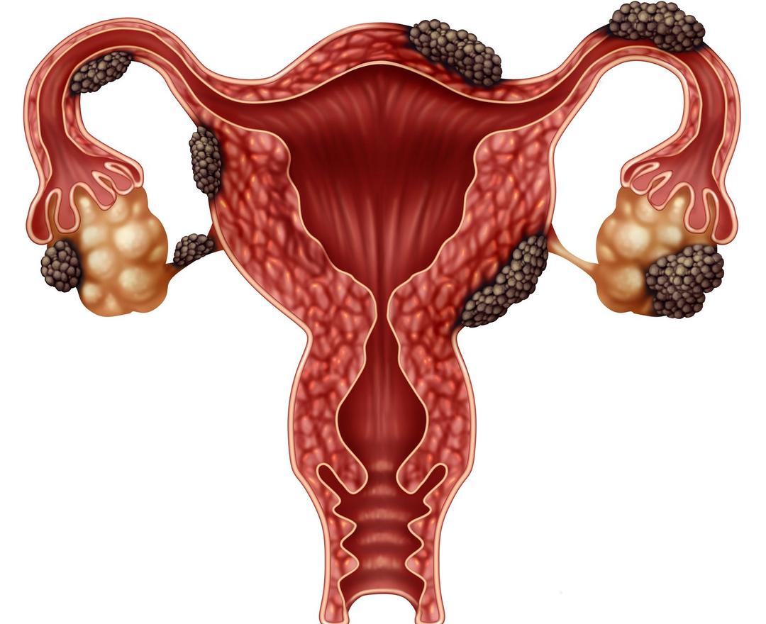 endometriosis 1x1.jpg