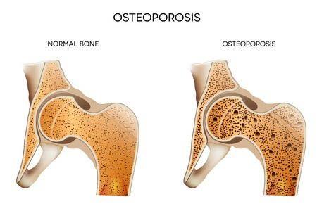 osteoporosis-graphic 1.jpeg