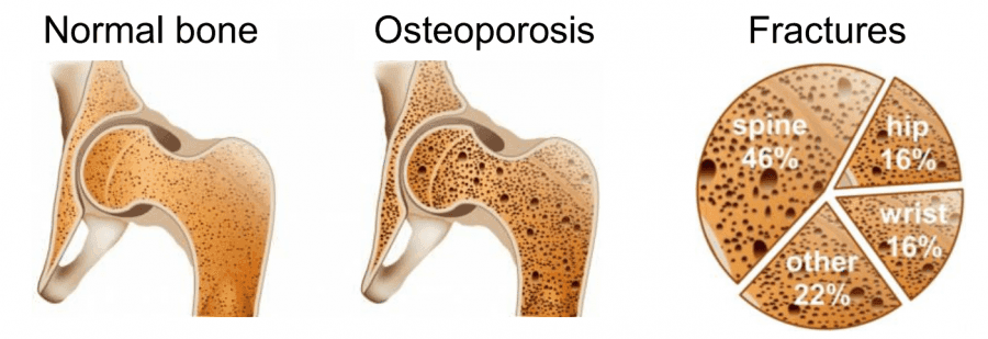 posteoporosis 2 long.png