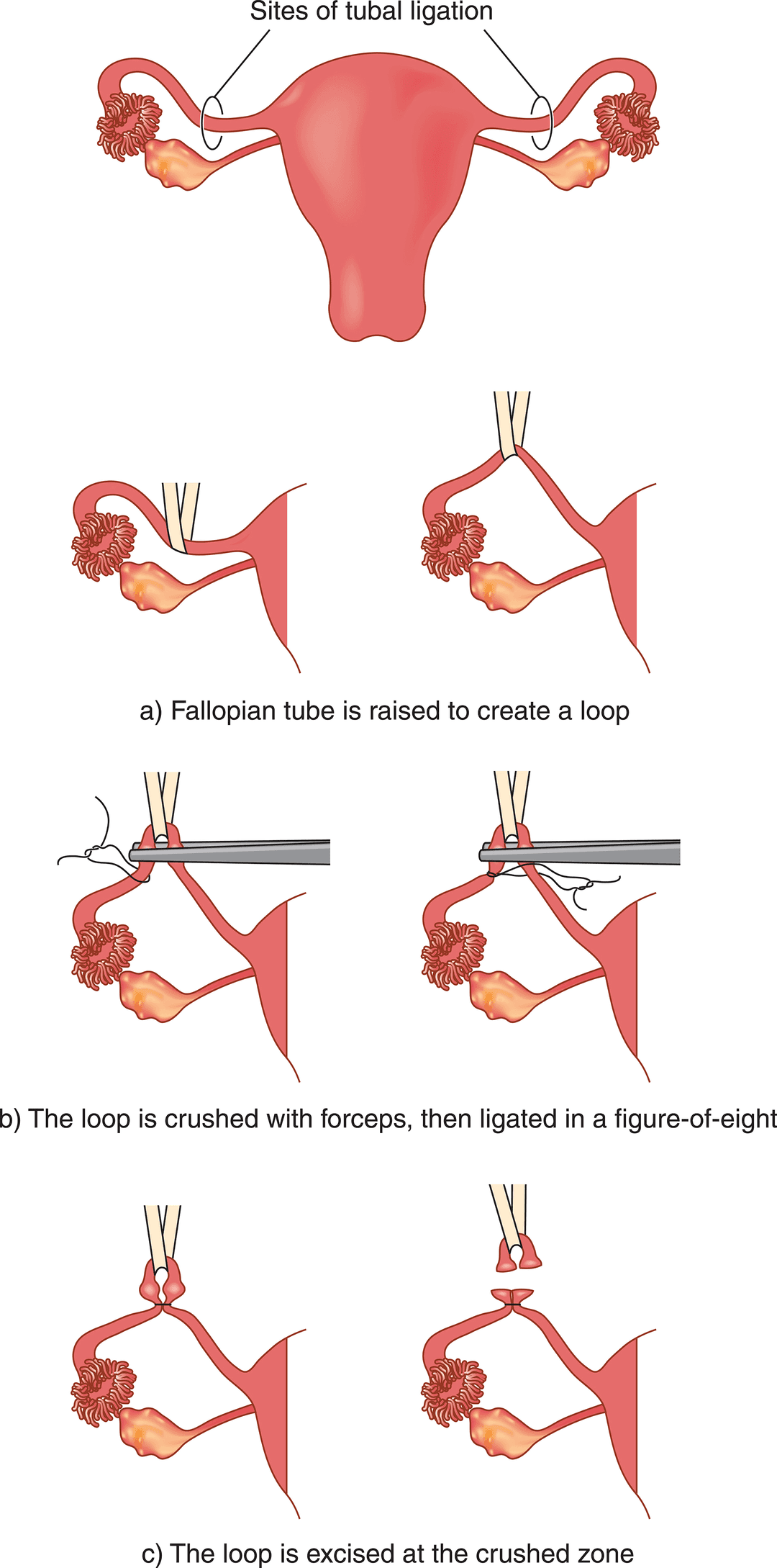 sterilisation.PNG